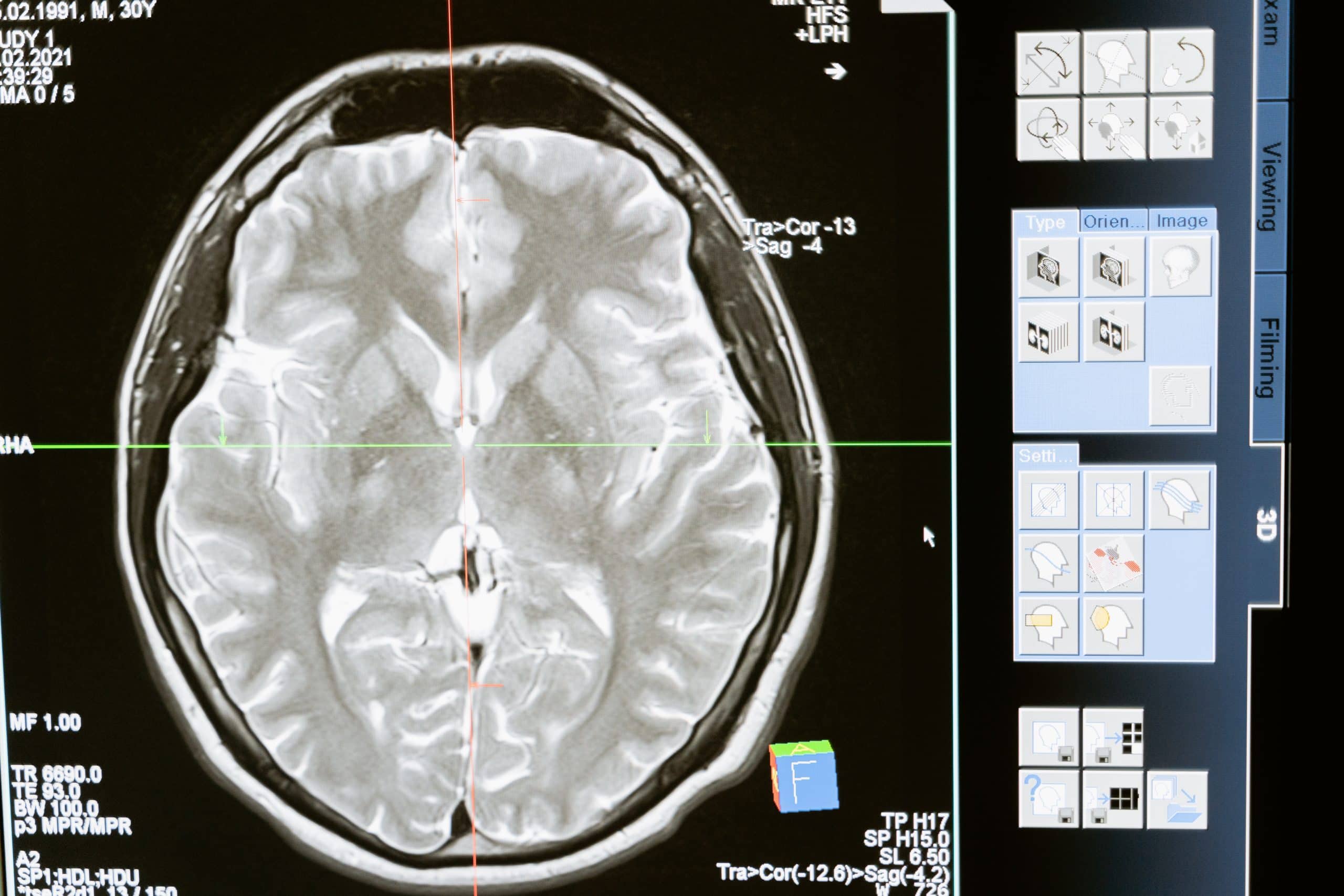 Brain scan used by a brain injuries lawyers in determining the compensation amount